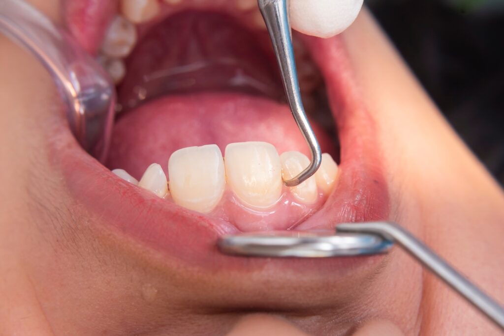 Macro image of dental scaling on lower anterior teeth using a metal scaler to remove plaque and calculus bridge near the gum line.