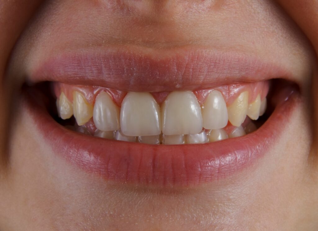 Learn how to remove plaque. Get insights from our Dental team at Edmonds Dental Care.