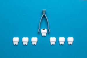 Learn everything you need to know about tooth extractions in Edmonds, WA.