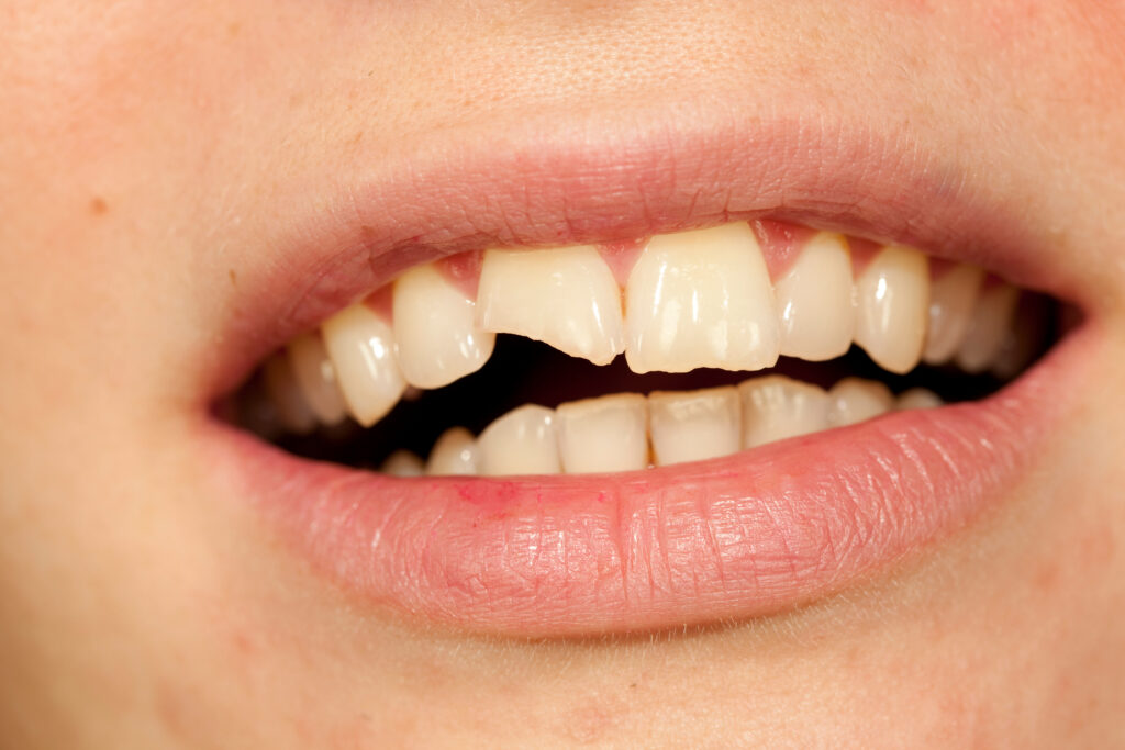 Here's what to do with a broken tooth