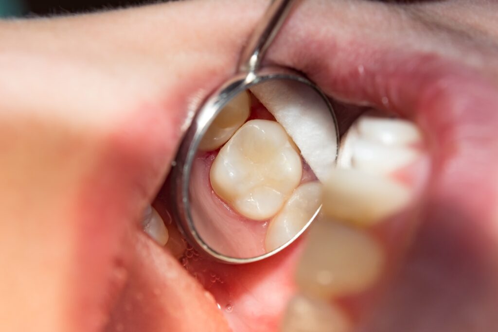 Everything you need to know about tooth fillings, types, and costs in Edmonds.