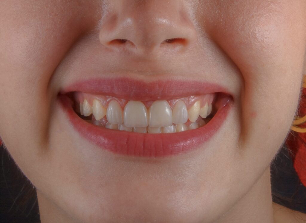 Can teeth grinding make teeth sensitive